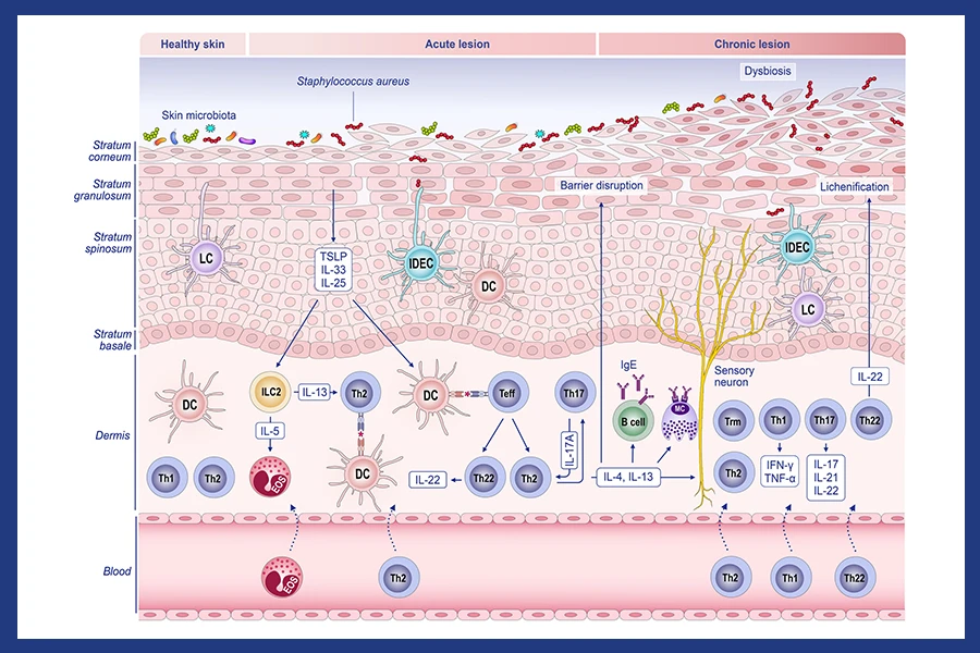 atopic dermatitis